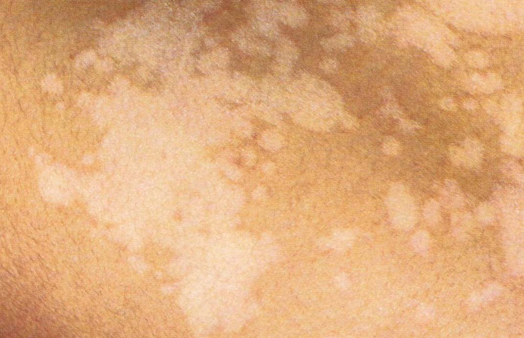 Les Mycoses De La Peau Et Les Huiles Essentielles Partie 2 Pityriasis Versicolor Et Herpes